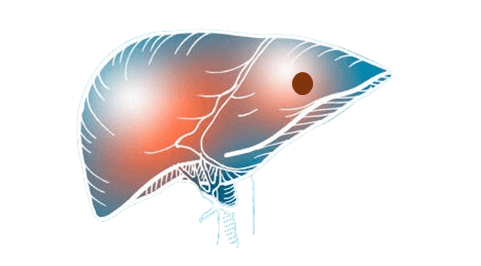 Image of early stage liver cancer